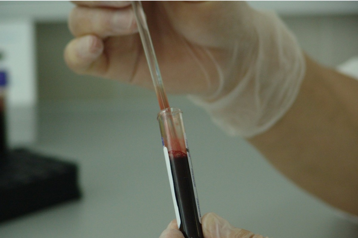 Ученые из Великобритании разработали анализ крови для прогнозирования риска смерти